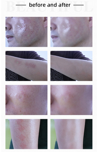 Produit Tendance 2026 : Laser Thulium à Double Longueur d'Onde (1927 et 1550 nm) pour le Resurfaçage Cutané, l'Élimination des Cicatrices et le Nettoyage du Visage - Product Image 5