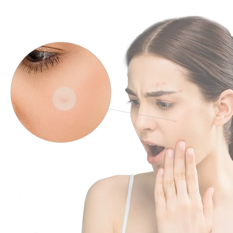 Fábrica direta aliviar adolescente acne patch menstrual acne patch óleo e acne no remendo rosto