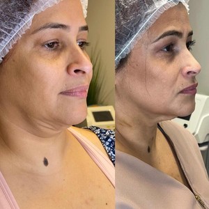 Máquina de Lipólisis con Resultados Efectivos, 980nm 1470nm, Máquina Endoláser de Alta Potencia, Lifting Facial, Lipólisis Láser, Máquina de Liposucción - Product Image 2