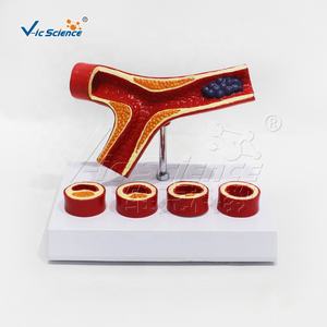 Y-образная модель атеросклероза артерии раздельная модель тромба анатомические модели анатомических моделей сосудов кровеносных сосудов - Product Image 3