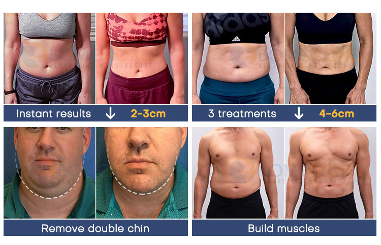 Best body sculpting machine