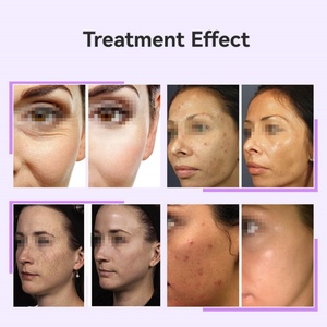 Máquina Facial Portátil de Electroterapia para el Cuidado de la Piel, Varita Galvánica de Alta Frecuencia - Product Image 3