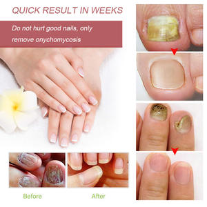 2025 Tik Tok Venta caliente Herbal Nail Foot Toe Nail Fungus Tratamiento Reparación de uñas Líquido Cuidado de los pies - Product Image 5