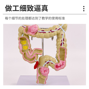 Modèle de simulation pédagogique de la pathologie du côlon, spécimen de lésion colorectale, communication médecin-patient sur les intestins, organe humain - Product Image 5