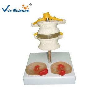 Modèle anatomique de la colonne vertébrale humaine avec deux disques intervertébraux lombaires et deux lésions Matériau en PVC Structure anatomique vive - Product Image 1