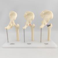 Modèle d'anatomie de l'articulation de la hanche, modèle de comparaison norme, arthrose et remplacement de la hanche, modèle pédagogique médical orthopédique, hauteur 240 mm