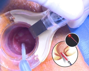Diodo láser cirugía 980nm hemorroides pilas buasir hemorroides fístula láser ablación proctología láser - Product Image 5