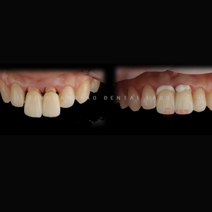 Fournitures pour prothèses dentaires Produits dentaires Placage en porcelaine Restauration de prothèses fixes <span class=keywords><strong>Sourire</strong></span> <span class=keywords><strong>parfait</strong></span> - Product Image 3