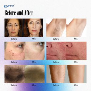 Máquina de depilación láser Alexandrite Nd Yag para eliminar vello y tatuajes - Product Image 6