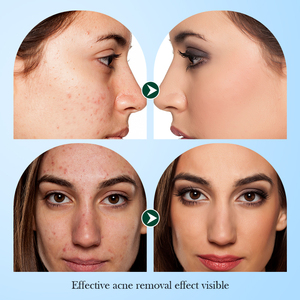SADOER Tea Tree Anti Acne Toner Control de aceite <span class=keywords><strong>Tónico</strong></span> <span class=keywords><strong>facial</strong></span> Hidratante Cuidado de la <span class=keywords><strong>piel</strong></span> <span class=keywords><strong>para</strong></span> <span class=keywords><strong>piel</strong></span> <span class=keywords><strong>grasa</strong></span> y propensa al acné - Product Image 5