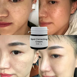 Crema Quita Manchas de Melasma, Elimina Pecas y Manchas Oscuras, Crema para Eliminar Pecas, Eliminador de Pigmentación para el Cuidado de la Piel del <span class=keywords><strong>Rostro</strong></span> - Product Image 4