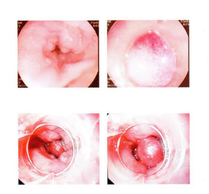 Ligatore Multi-Banda in Gomma per Endoscopia CE, per Varici Esofagee - Product Image 5