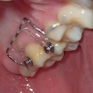 Bottone linguale ortodontico con Base in rete incollabile dentale di alta qualità con tacchetta - Product Image 6