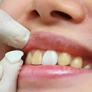 Facettes dentaires en porcelaine bleue tout céramique Dentsply Ivoire, faits à la main, en porcelaine ambrée, sans grincement des dents - Product Image 2