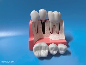 Modèle de dents dentaires modèle de Solution d'<span class=keywords><strong>implant</strong></span> 4 fois restauration de prothèse <span class=keywords><strong>dentaire</strong></span> explication d'<span class=keywords><strong>implant</strong></span> <span class=keywords><strong>dentaire</strong></span> <span class=keywords><strong>couronne</strong></span> de pont détachable - Product Image 5