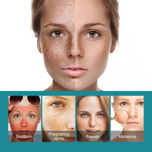 EELHOE sbiancante lentiggini <span class=keywords><strong>crema</strong></span> per la rimozione delle macchie scure Melasma scottature da sole macchie di gravidanza che riducono la pelle idratante <span class=keywords><strong>crema</strong></span> riparatrice - Product Image 6