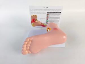 Modè<span class=keywords><strong>le</strong></span> de pied pathologique en PVC de marque Yulin pour la communication avec <span class=keywords><strong>les</strong></span> patients, pour la goutte, <span class=keywords><strong>les</strong></span> complications, l'arthrite, l'articulation du pied <span class=keywords><strong>et</strong></span> de la cheville - Product Image 3