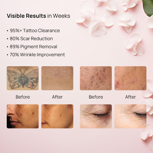 Meilleure vente Winkonlaser Laser picoseconde Q-switched Nd Yag pour l'élimination de tous les types de tatouages et de mélasma - Product Image 3
