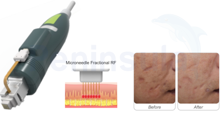 Peninsula Fractional RF Micro Needle Skin Care System 240V 6