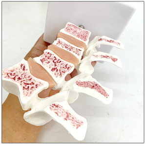 Modelo de osteoporosis de hueso humano Anatomía lumbar patológica Modelo de enseñanza de sección transversal espinal - Product Image 3