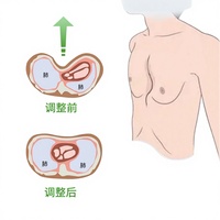 Vente chaude : Cloches à vide pour le traitement du pectus excavatum / poitrine encastrée – Traitement non chirurgical