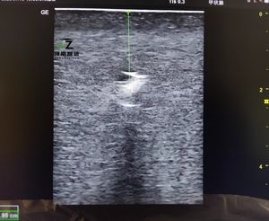 แบบจำลองการสอนการเจาะเนื้อเยื่อภายใต้การนำทางด้วยอัลตราซาวด์ (สีผิว) - Product Image 3