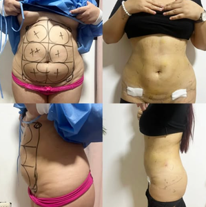 Máquina <span class=keywords><strong>de</strong></span> Lifting Facial Endoláser 2026 para <span class=keywords><strong>Papada</strong></span>, Levantamiento <span class=keywords><strong>de</strong></span> Cuello y Bolsas <span class=keywords><strong>de</strong></span> Ojos con Láser <span class=keywords><strong>de</strong></span> Fibra 980 1470nm - Product Image 5