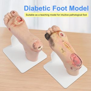 Modelo de pie diabético (leve/severo) para formación médica, maniquí preventivo para el pie diabético, silicona CE/ISO - Product Image 3