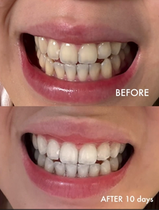 Dispositivo de Blanqueamiento Dental LED Rojo y Azul, Sin Sensibilidad, Carga Inalámbrica, Diseño Portátil, Regalo Perfecto para la Belleza Dental Personal - Product Image 6