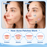 Patchs Hydrocolloïdes Décoratifs en Gros pour Boutons, Autocollants Mignons en Forme de Patte de Chat pour l'Acné, Soin des Imperfections du Visage