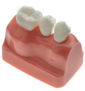 Gelsonlab HSDT-M3 4 Volte <span class=keywords><strong>Implant</strong></span> Denti Modello Dentale Modello di Impianto Analisi <span class=keywords><strong>Crown</strong></span> Ponte Dimostrazione Denti Modello per la Formazione - Product Image 4
