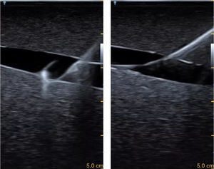 Simulador de Entrenamiento ECMO - Modelo de Entrenamiento para Punción Arterio-Venosa Femoral Guiada por Ultrasonido - Product Image 3