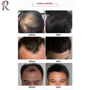 Equipo Multifuncional para el Cuidado del Cuero Cabelludo para Centros Profesionales de Tratamiento de la Caída del Cabello, Tratamiento de la <span class=keywords><strong>Dermatitis</strong></span> Seborreica del Cuero Cabelludo - Product Image 4