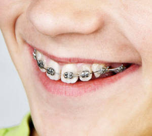 Soporte dental fijo con arco, material <span class=keywords><strong>de</strong></span> alambre para <span class=keywords><strong>dientes</strong></span> <span class=keywords><strong>de</strong></span> ortodoncia, desechable, <span class=keywords><strong>de</strong></span> metal - Product Image 2