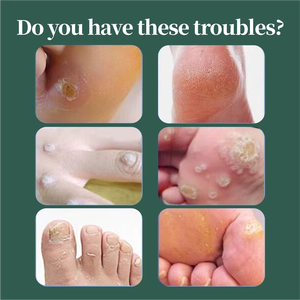 Cerotto Medico per la Protezione dei <span class=keywords><strong>Piedi</strong></span>, Sollievo dal Dolore e Rimozione dei <span class=keywords><strong>Calli</strong></span> - Product Image 2