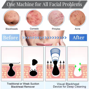 เครื่องดูดสิวเสี้ยน เครื่องดูดสิวเสี้ยนแบบสุญญากาศ เครื่องทำความสะอาดผิวหน้า - Product Image 6