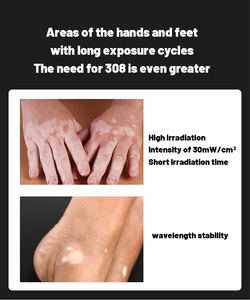 2025 Produk Terlaris 308Nm Output Cahaya Excimer Panjang Gelombang Tunggal melalui Medium Xecl Perawatan Tanpa Rasa Sakit - Product Image 4