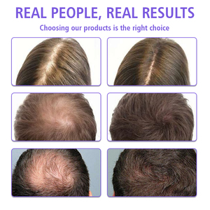 Joynna Chăm Sóc Mùa Thu Kiểm Soát Muối Miễn Phí Cho Tóc Mỏng Nhân Sâm Renew Thảo Dược Phosphate Chống Kiểm Soát Dầu Mose Tóc Calar Dầu Gội - Product Image 3