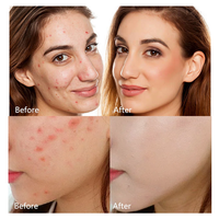 Éliminez l'acné du visage avec 40 patchs anti-acné en forme d'étoile, contenant de l'extrait de Centella Asiatica et de l'huile d'arbre à thé