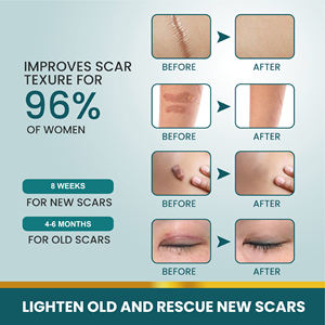 แผ่นแผลเป็นซิลิโคนใสไร้กลิ่นมีกลิ่นสมุนไพรธรรมชาติ1.5เมตร - Product Image 4