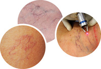Appareil laser diode professionnel portable 980nm 1470 pour l'élimination vasculaire, traitement des varices, des capillaires, des veines d'araignée et des mycoses cutanées