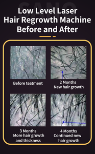 Máquina Profesional Taibo para el Crecimiento del Cabello, Detiene la Caída del Cabello, Terapia de Rejuvenecimiento del Cuero Cabelludo, Masajeador de Cuero Cabelludo con Fotones de 650nm, Máquina para el Recrecimiento del Cabello - Product Image 5