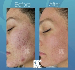 CO2 fractional Laser máy Laser CO2 fraccionado máy được sử dụng để giải quyết vấn đề vẻ đẹp trên khuôn mặt - Product Image 3