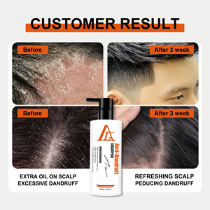 Crema Champú Antifúngica 2 en 1, Fórmula de Limpieza Profunda, Control de Grasa para <span class=keywords><strong>Dermatitis</strong></span> Seborreica, Alivio de la Psoriasis del Cuero Cabelludo - Product Image 5