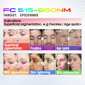 Máquina Antienvejecimiento BBL <span class=keywords><strong>Plus</strong></span> de Nivel Médico, Dispositivo Reafirmante Antiarrugas para Cuello, Rostro y Cuerpo Completo - Product Image 2