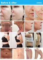 Appareil Cryo-RF 2026 à succès pour le raffermissement cutané, cryoliposuccion non invasive et lifting des fesses pour une réduction précise de la graisse