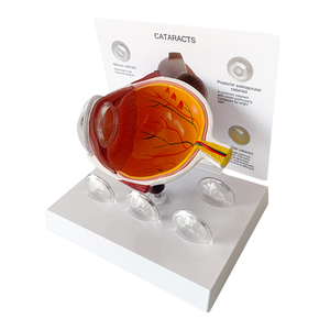 Modelo <span class=keywords><strong>de</strong></span> ojos para mostrar la ciencia médica, patología humana, para educación - Product Image 1