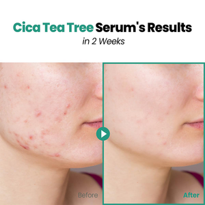 Suero facial de árbol de té Cica, extractos botánicos, tratamiento calmante transparente para la piel, repara el suero de la piel dañada, antienvejecimiento - Product Image 6