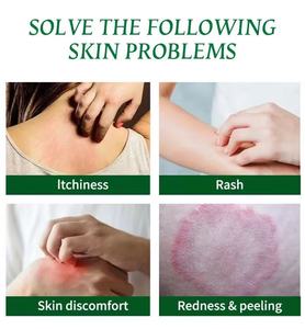 Crème naturelle à base de plantes chinoises pour l'eczéma, vente chaude, crème contre les démangeaisons cutanées et les infections fongiques - Product Image 4