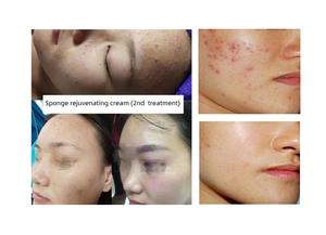 Suero Crema Esencial de Microagujas Rosa OEM para Tensar y Reducir Poros en Medicina Estética y Belleza - Product Image 5